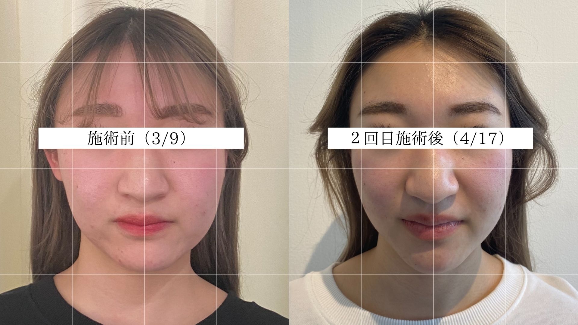 美容鍼ビフォーアフター