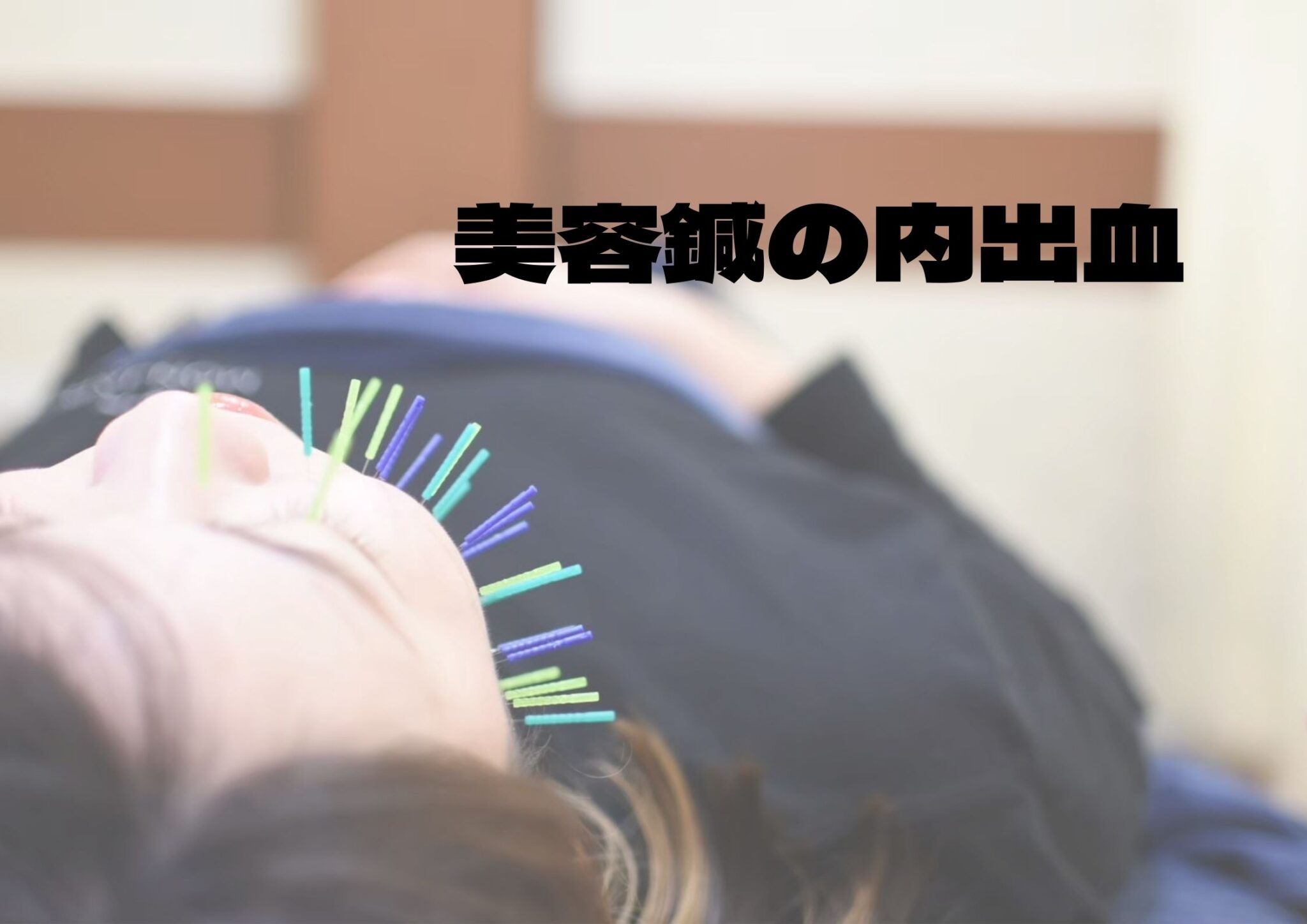 美容鍼の内出血