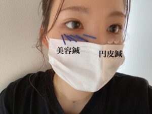 美容鍼　目の下のたるみ
