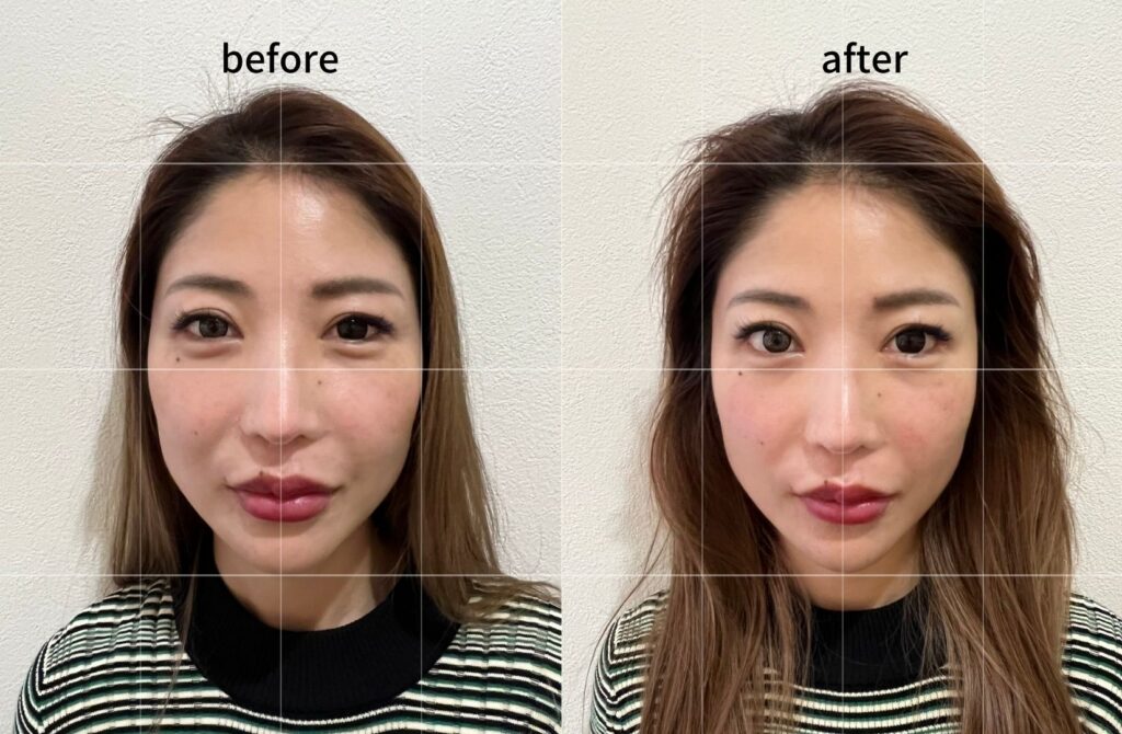 もんじゃるでの美容鍼施術でのビフォーアフター画像。フェイスライン、むくみ改善がしっかりわかります。
