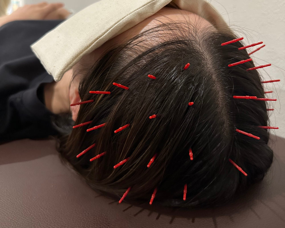 眠り鍼 不眠症改善
