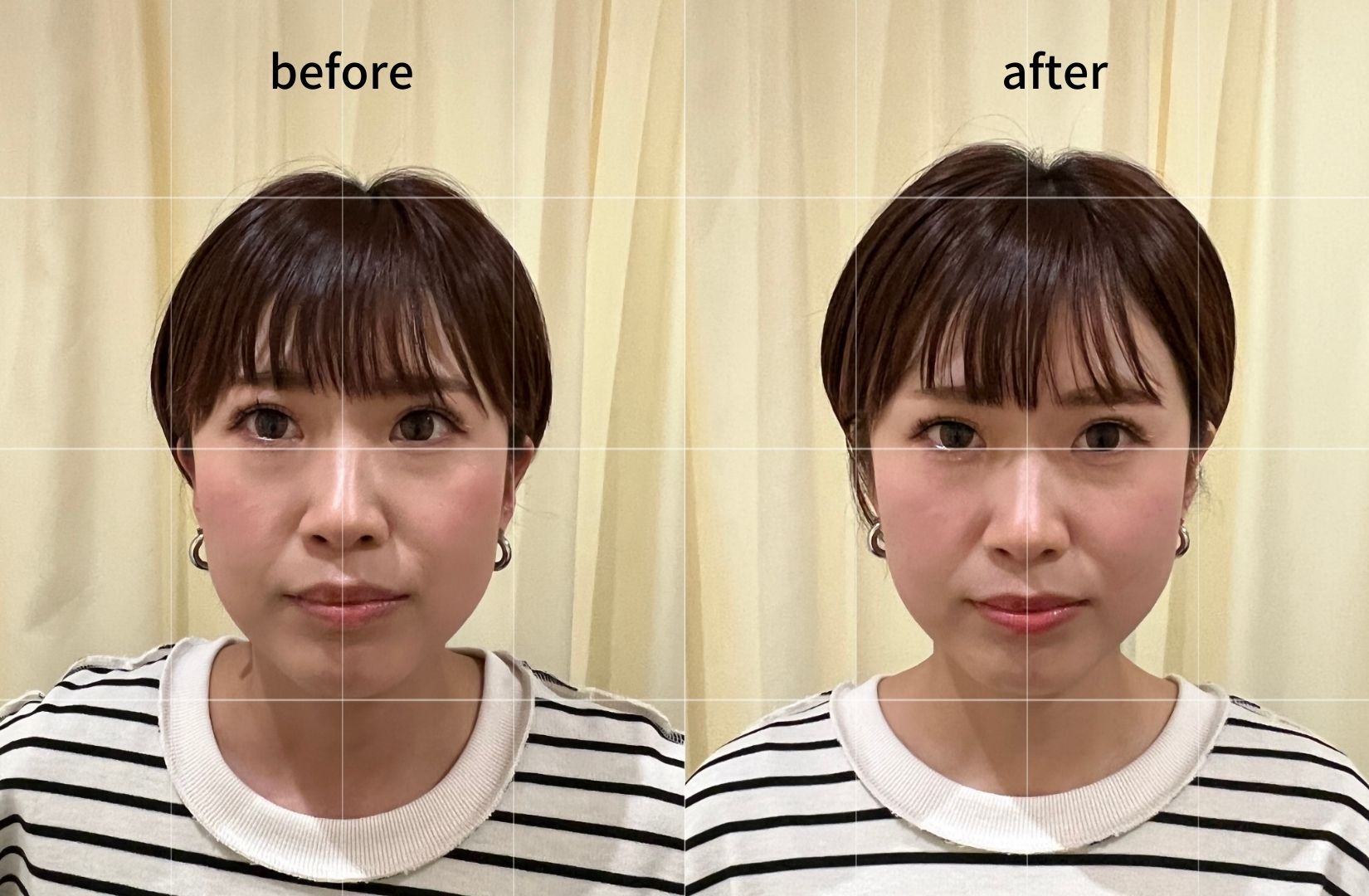 美容鍼極ba2