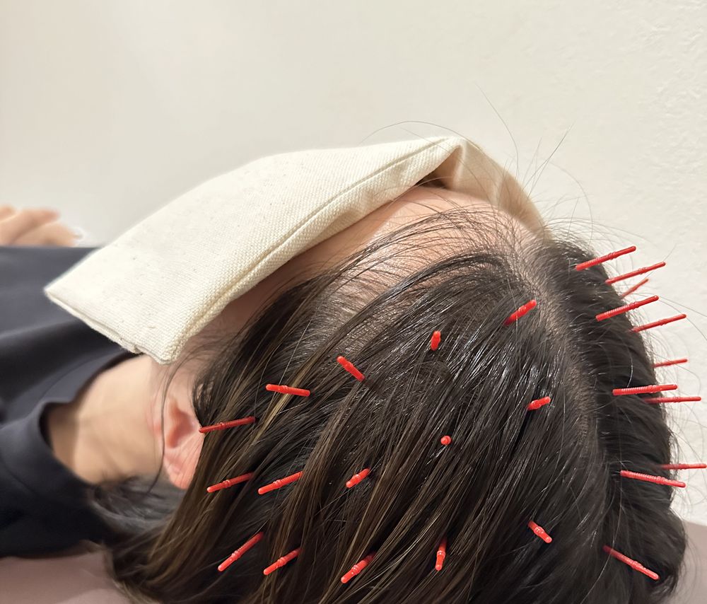 頭への鍼（眠り鍼）の施術