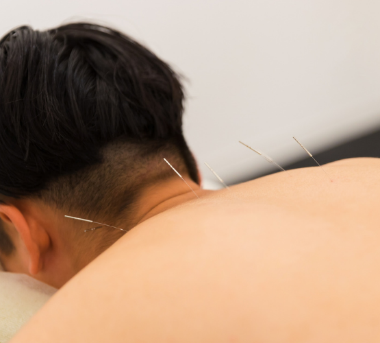 肩の痛みがある患者に対し、鍼治療を行っている様子。